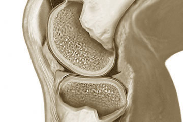 Protektive Knorpelschutztherapie