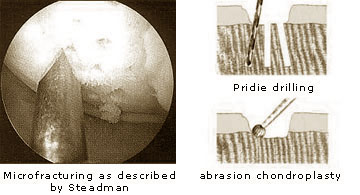 Microfracturing nach Steadman, Abrasionschondroplastik, Pridie-Bohrung Schaubild-en
