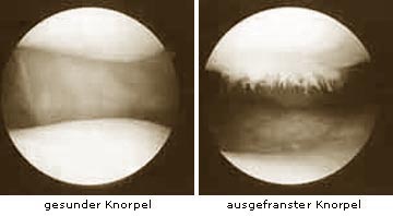 gesunder Knorpel und ausgefranster Knorpel Schaubild-Athroskopie-en